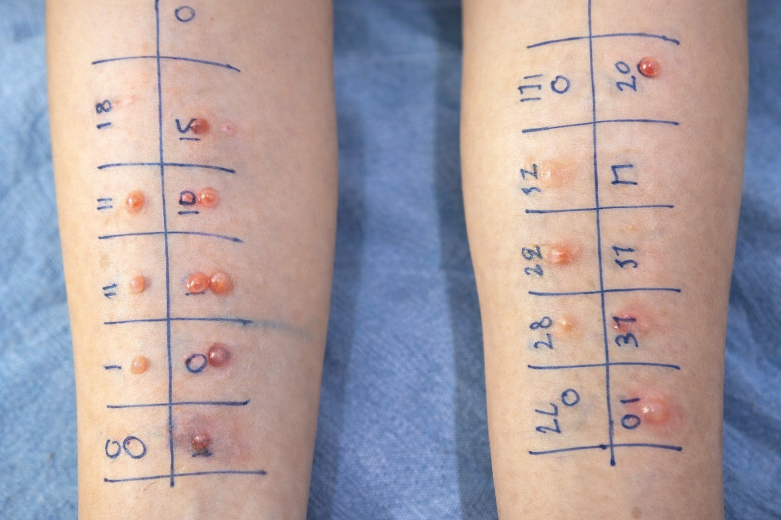 Allergy Management – Causes, Symptoms & Long-Term Relief